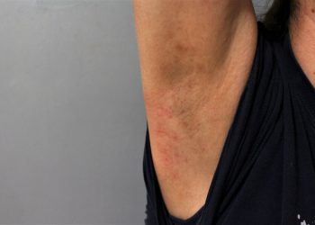 underarm rash