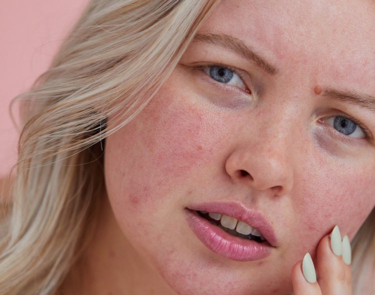 How a Healthy Skin Barrier Helps Keep Skin Clear