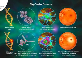 genetic disorder - Tau-Sachs Disease