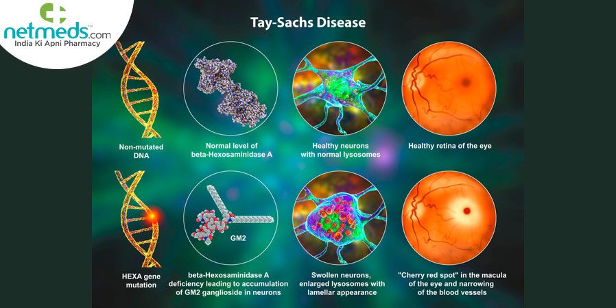 genetic disorder - Tau-Sachs Disease