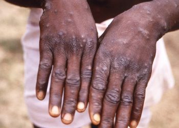 Monkeypox Spreads in West, Baffling African Scientists