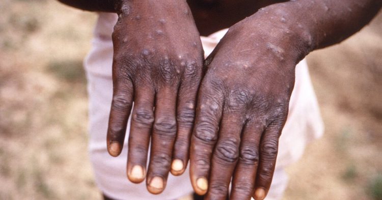 Monkeypox Spreads in West, Baffling African Scientists