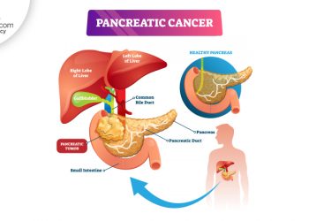 Pancreatic Cancer
