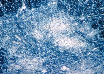 First Polio Case in Nearly a Decade Is Detected in New York State