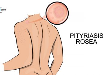 Pityriasis rosea