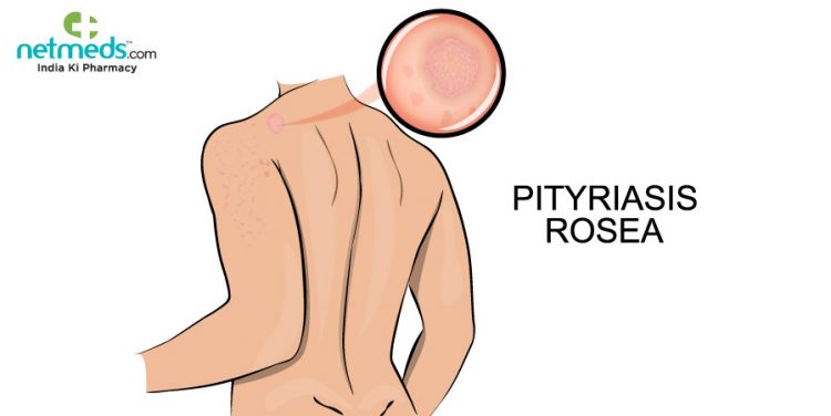 Pityriasis rosea