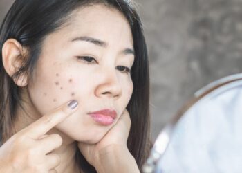 Skin Care For Acne Prone dry Skin